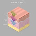 3D Isometric Flat Vector Illustration of Skin Chemical Peel