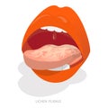 3D Isometric Flat Vector Illustration of Sore Or White Tongue. Item 2