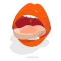 3D Isometric Flat Vector Illustration of Sore Or White Tongue. Item 1