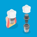 3D Isometric Flat Vector Illustration of Tooth implant Royalty Free Stock Photo