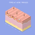 3D Isometric Flat Vector Illustration of Types Of Acne Papules
