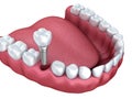 3d lower teeth and dental implant isolated