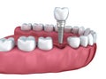 3d lower teeth and dental implant isolated