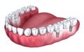 3d lower teeth and dental implant isolated