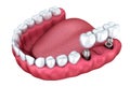 3d lower teeth and dental implant