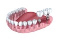 3d lower teeth and dental implant transparent render