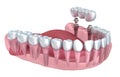 3d lower teeth and dental implant transparent render