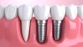 Comparison of a natural tooth root and two dental implants in a gum cross-section teeth Royalty Free Stock Photo