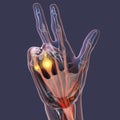 A 3D medical illustration displaying a patient& x27;s hand with Dupuytren& x27;s contracture, emphasizing the affected