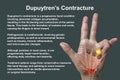 A 3D medical illustration displaying a patient& x27;s hand with Dupuytren& x27;s contracture, emphasizing the affected