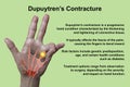 A 3D medical illustration displaying a patient& x27;s hand with Dupuytren& x27;s contracture, emphasizing the affected