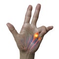 A 3D medical illustration displaying a patient& x27;s hand with Dupuytren& x27;s contracture, emphasizing the affected