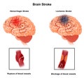 Medical illustration of Human Brain  arteries  blockage Royalty Free Stock Photo