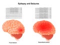 Medical illustration of Human Brain Epilepsy and Seizures Royalty Free Stock Photo