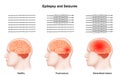 Medical illustration of Human Brain Epilepsy and Seizures Royalty Free Stock Photo