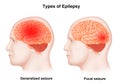 Medical illustration of Human Types of epilepsy