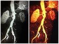 3d mra atrophic kidney ectatic iliac arteries thrombus