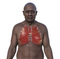 A man with lung miliary tuberculosis, 3D illustration