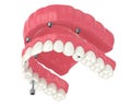 3d render of all on 4 dental implants treatment