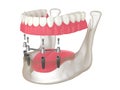 3d render of bar retained removable overdenture installation supported by four implants Royalty Free Stock Photo