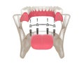 3d render of bar retained removable overdenture installation supported by four implants
