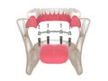 3d render of bar retained removable overdenture installation supported by four implants Royalty Free Stock Photo