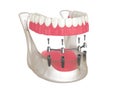 3d render of bar retained removable overdenture installation supported by four implants