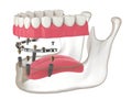 3d render of bar retained removable overdenture installation supported by implants