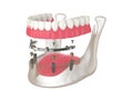 3d render of bar retained removable overdenture installation supported by implants