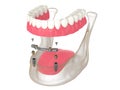 3d render of bar retained removable overdenture installation supported by two implants