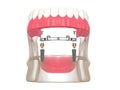3d render of bar retained removable overdenture installation supported by two implants
