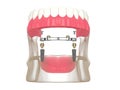 3d render of bar retained removable overdenture installation supported by two implants Royalty Free Stock Photo