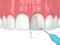 3d render of crooked tooth treatment using bonding procedure