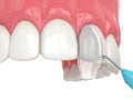 3d render of crooked tooth treatment using bonding procedure