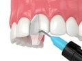 3d render of crooked tooth treatment using bonding procedure