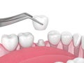 3d render of crown replacement on reshaped tooth