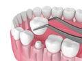 3d render of crown replacement on reshaped tooth Royalty Free Stock Photo