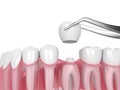 3d render of crown replacement on reshaped tooth Royalty Free Stock Photo