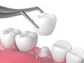 3d render of crown replacement on reshaped tooth