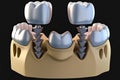 3d render of crown support for implanted teeth