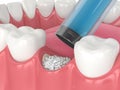 3D render of dental bone grafting with dental bone biomaterial application Royalty Free Stock Photo
