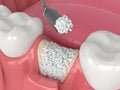 3D render of dental bone grafting with bone biomaterial application Royalty Free Stock Photo