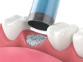 3D render of dental bone grafting with dental bone biomaterial application Royalty Free Stock Photo