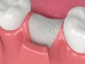 3D render of dental bone grafting with bone biomaterial and membrane Royalty Free Stock Photo