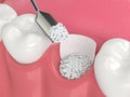3D render of dental bone grafting with bone biomaterial and membrane Royalty Free Stock Photo