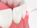 3d render of dental diode laser used to treat gums