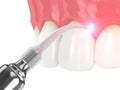 3d render of dental diode laser used to treat gums