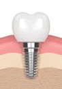 3d render of dental implant in gums