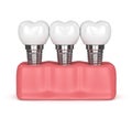 3d render of dental implants in gums