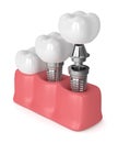 3d render of dental implants in gums